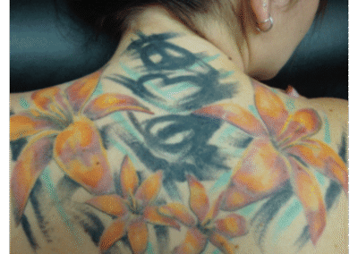 tattoo removal before and after