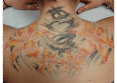 tattoo removal before and after