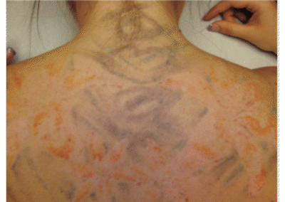 tattoo removal before and after