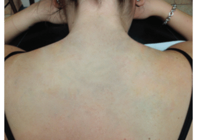 tattoo removal before and after