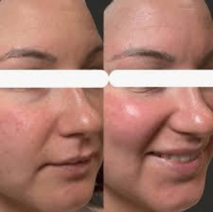 NaturaPeel Facial NaturaPeel Facial
