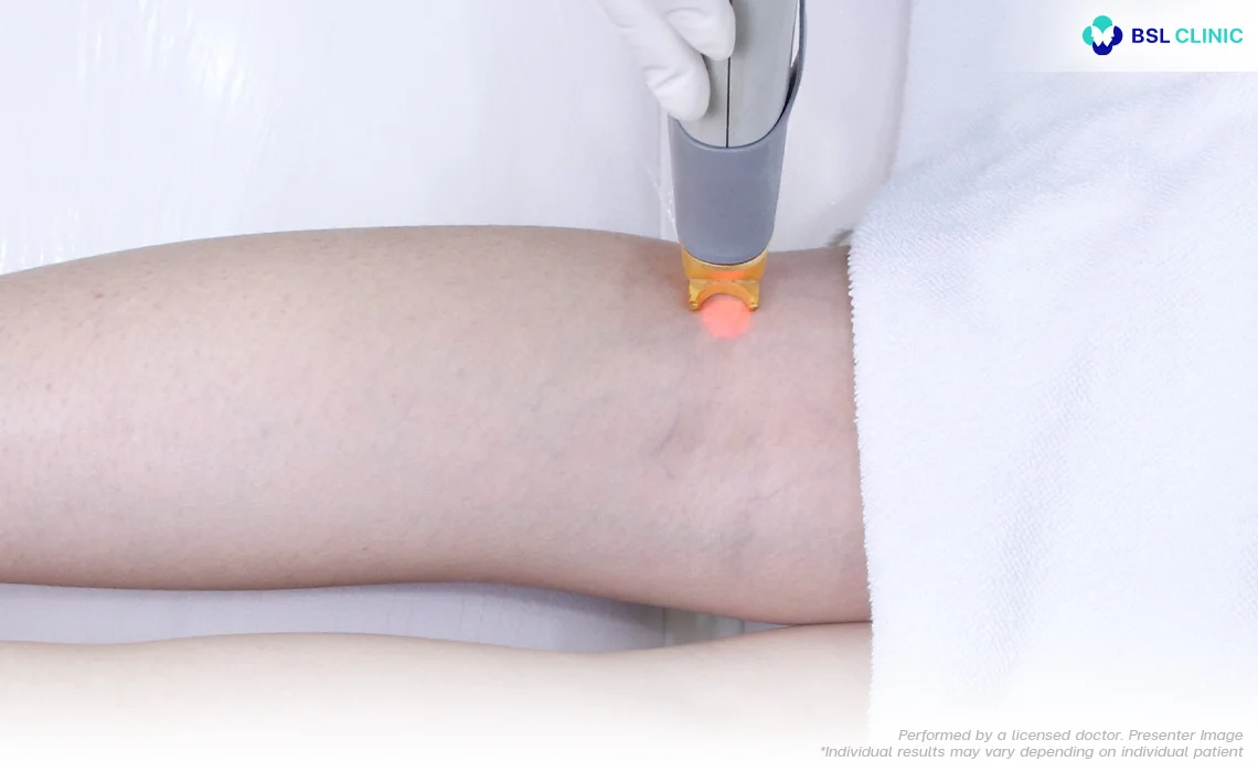Capillary Veins