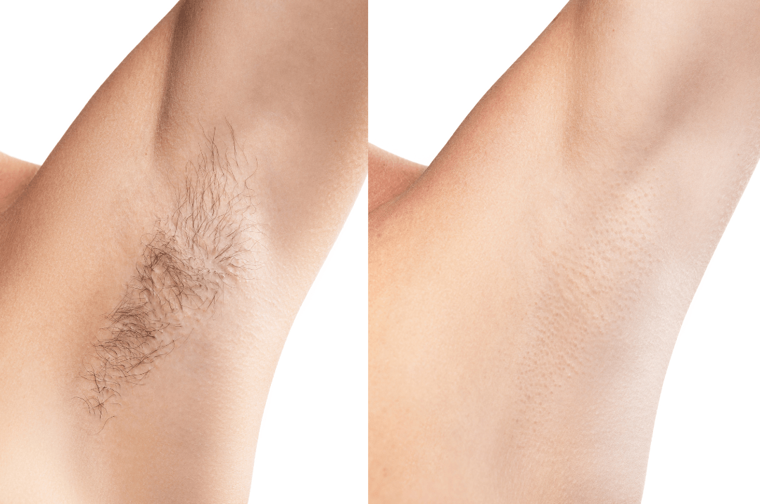 armpit hair removal for women