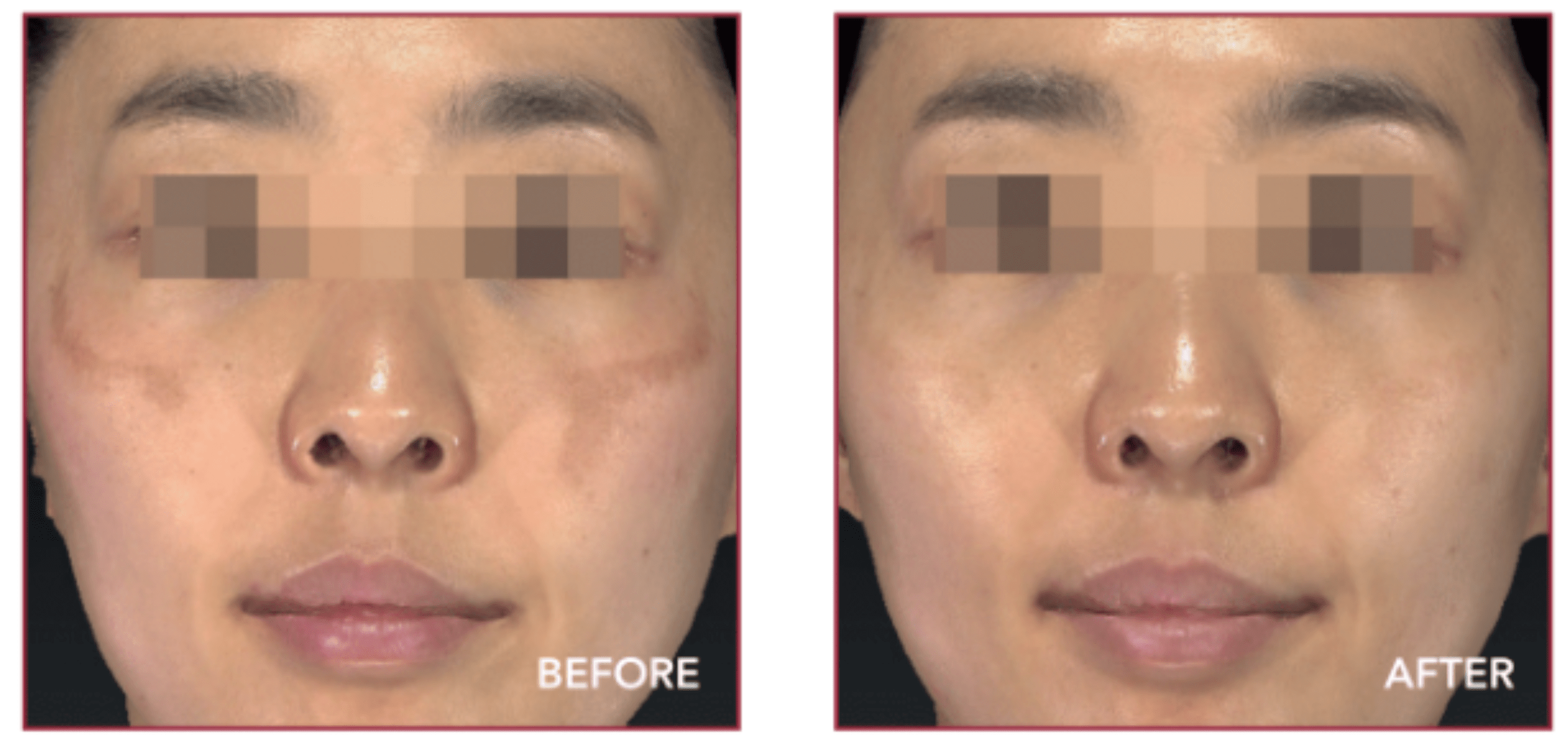 Melasma