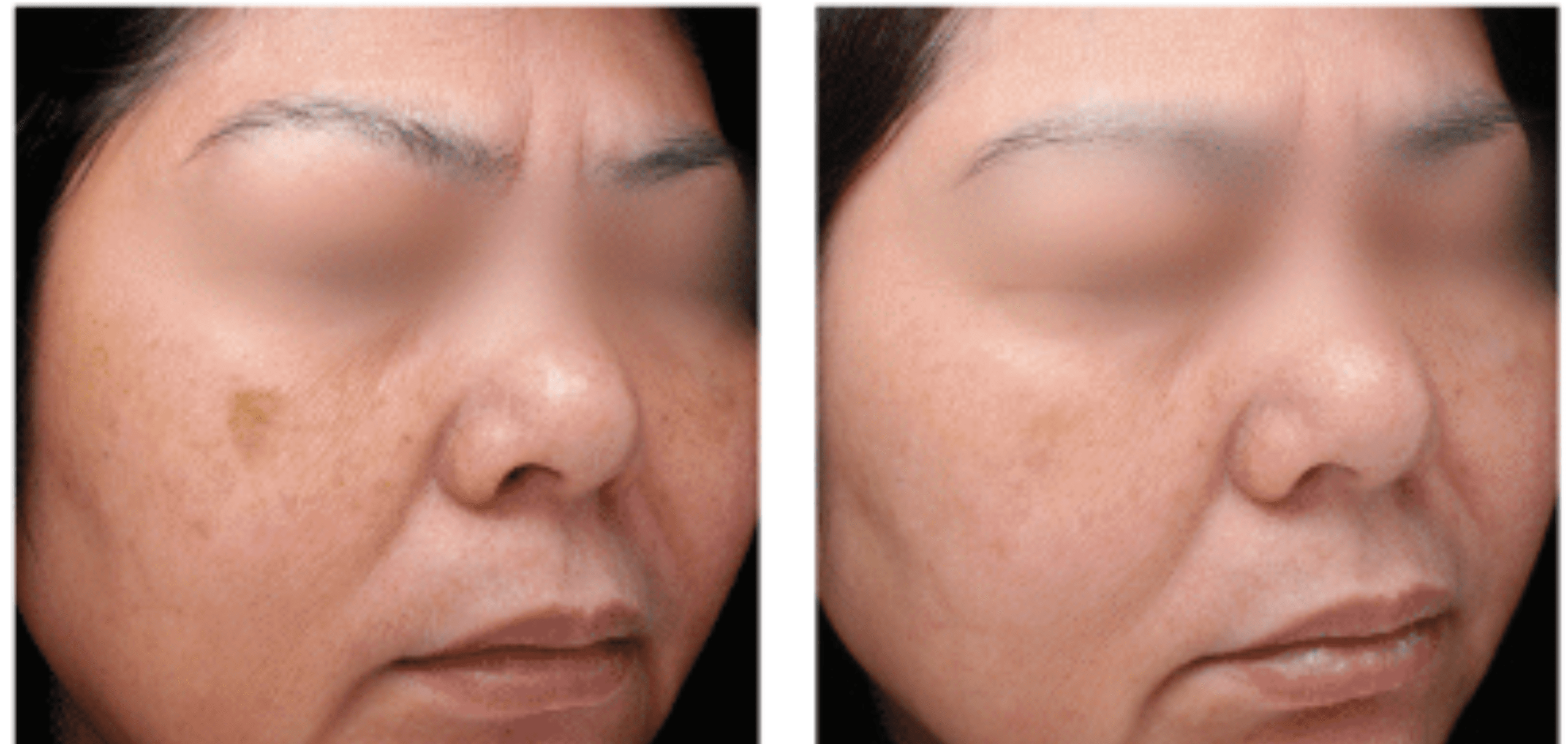 Melasma