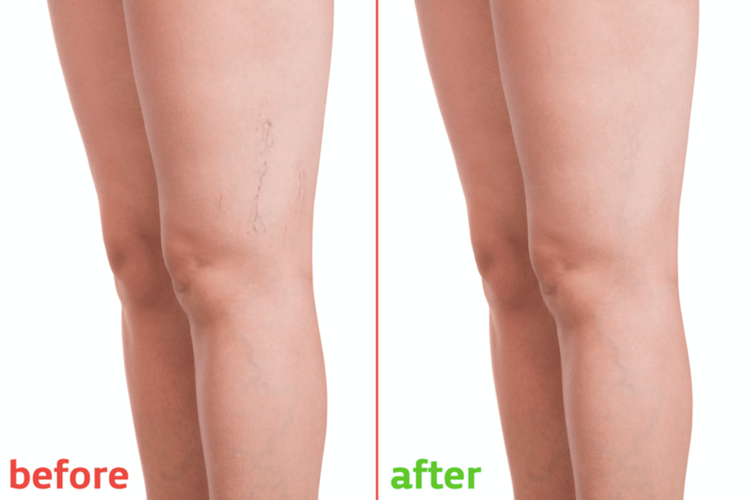 Capillary vein treatment