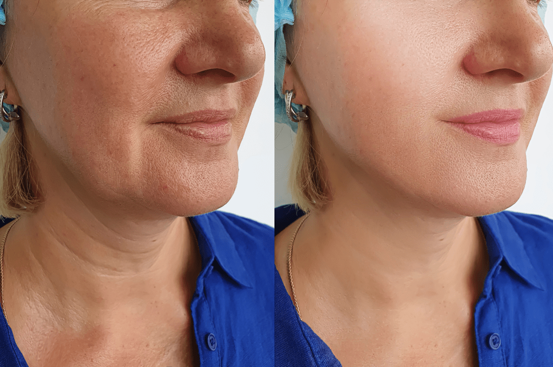 laser skin resurfacing before and after laser skin resurfacing before and after