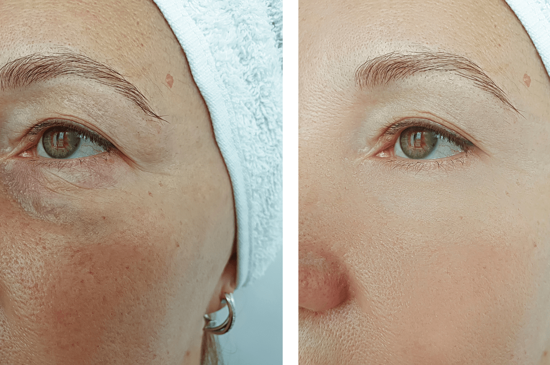 laser skin resurfacing before and after laser skin resurfacing before and after