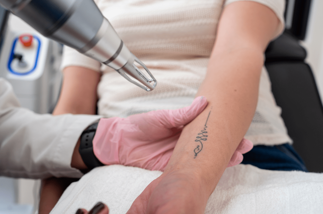 laser treatment for tattoo removal