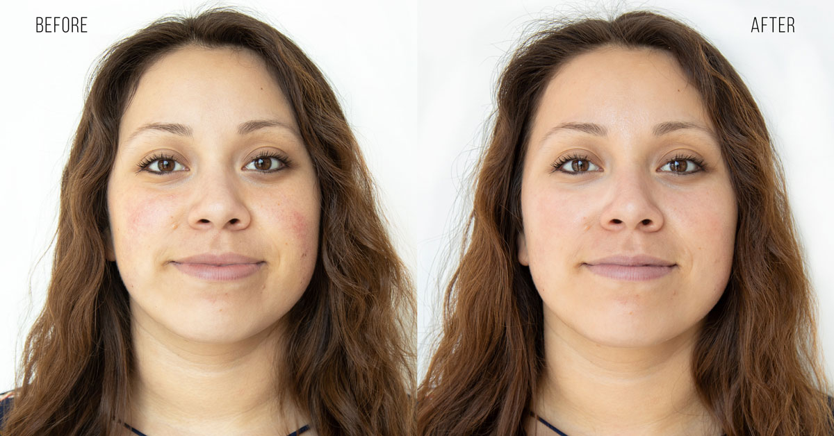 hydrafacial before and after